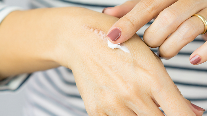 Narbenpflege Narbenpflege